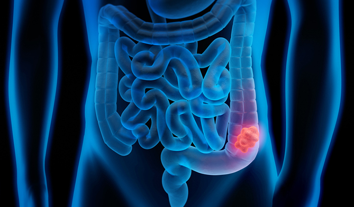 Colorectal Cancer Screening Roadmap