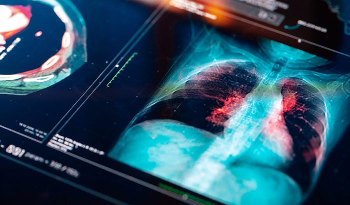Achieving Appropriate, Safe, and Patient-Centered Lung Cancer Screening