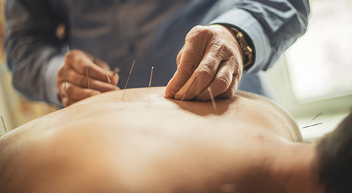 Close-up view of a man lying face down and being treated by the acupuncturist. He's applying the needle on man's back area.